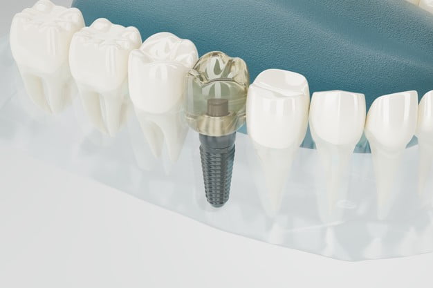 dental implant vs bridge