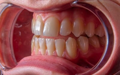 How to Recognize the Signs of Gum Disease and What to Do About It?