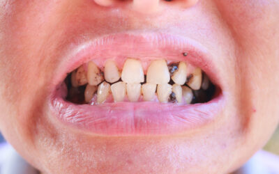 How Prescription Medications Cause Dry Mouth and Tooth Decay?