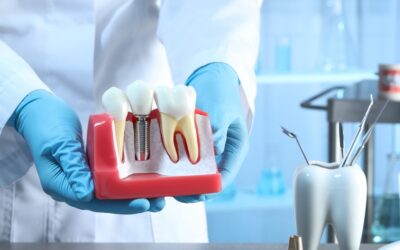 Choosing Between Implants and Dentures for Your Smile Restoration